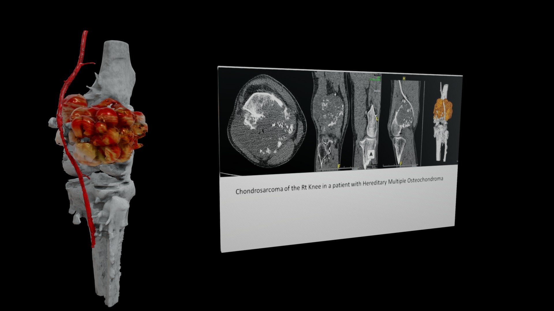 Chondrosarcoma Distal Femur