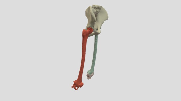 Pelvis, Femurs, and Artificial Knee 3D Model