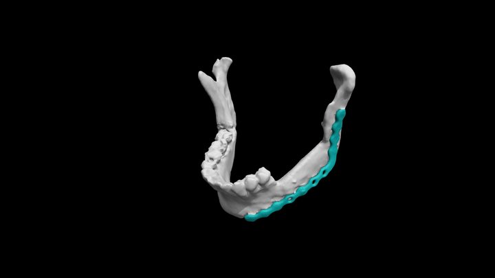 Mandible and plate 3D Model