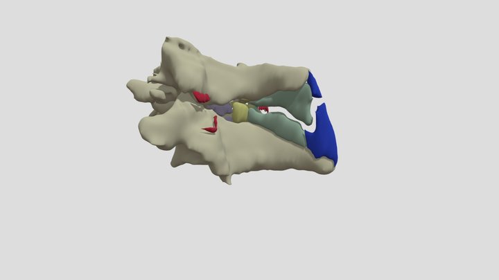 C6-7 Mild Facet Subluxation 3D Model