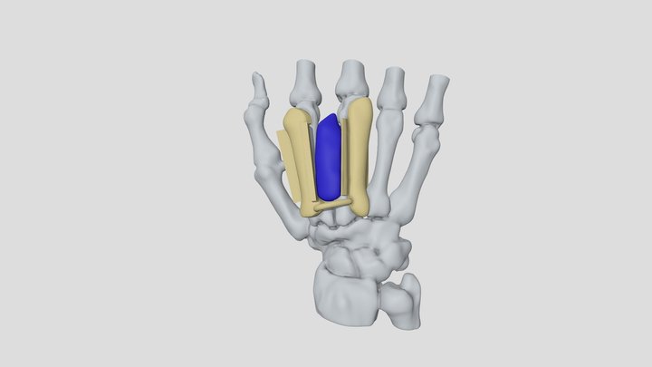 TumorManoGUIA001 3D Model