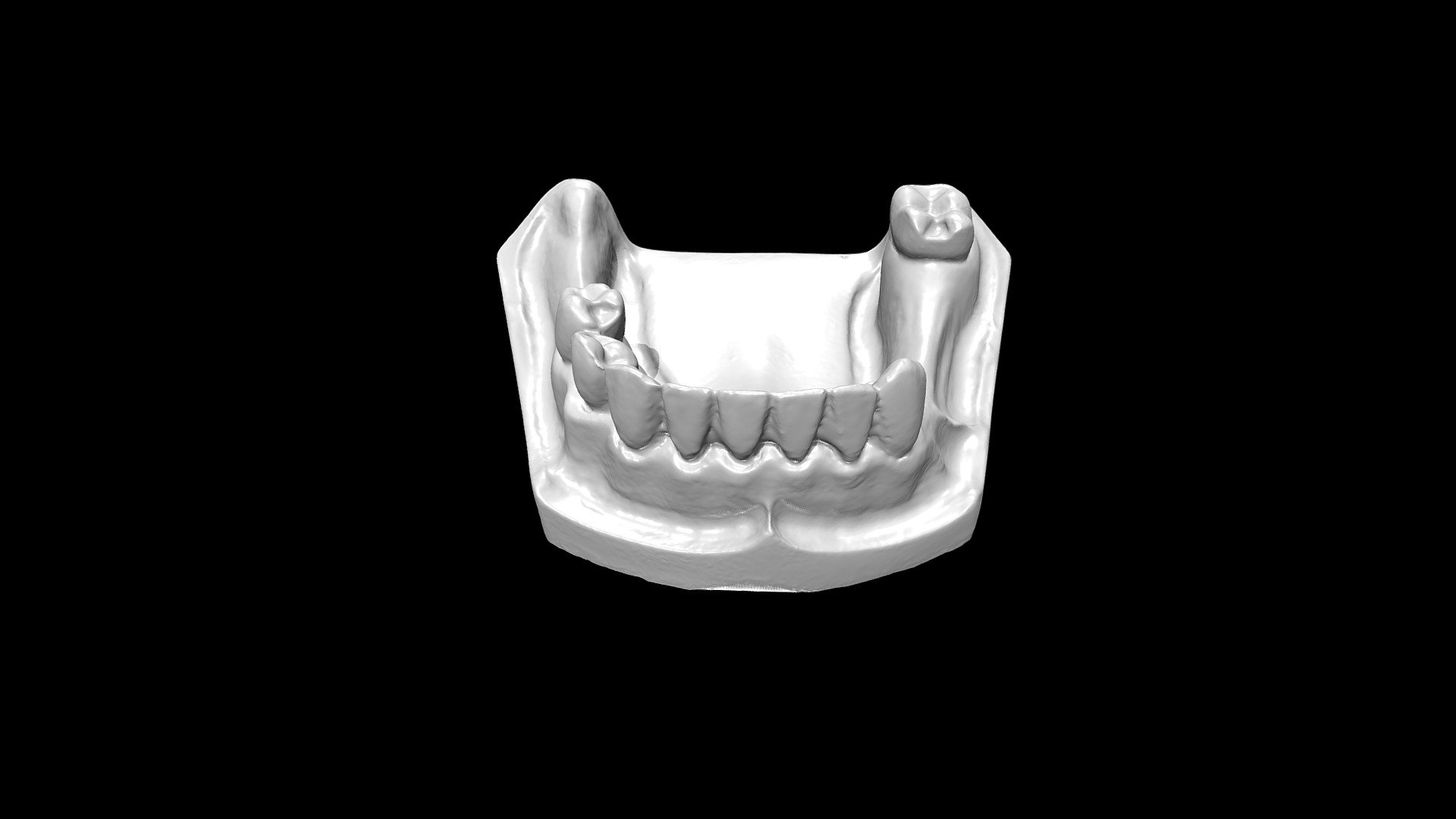 RPD Exercise: Modified dentoform - High Res