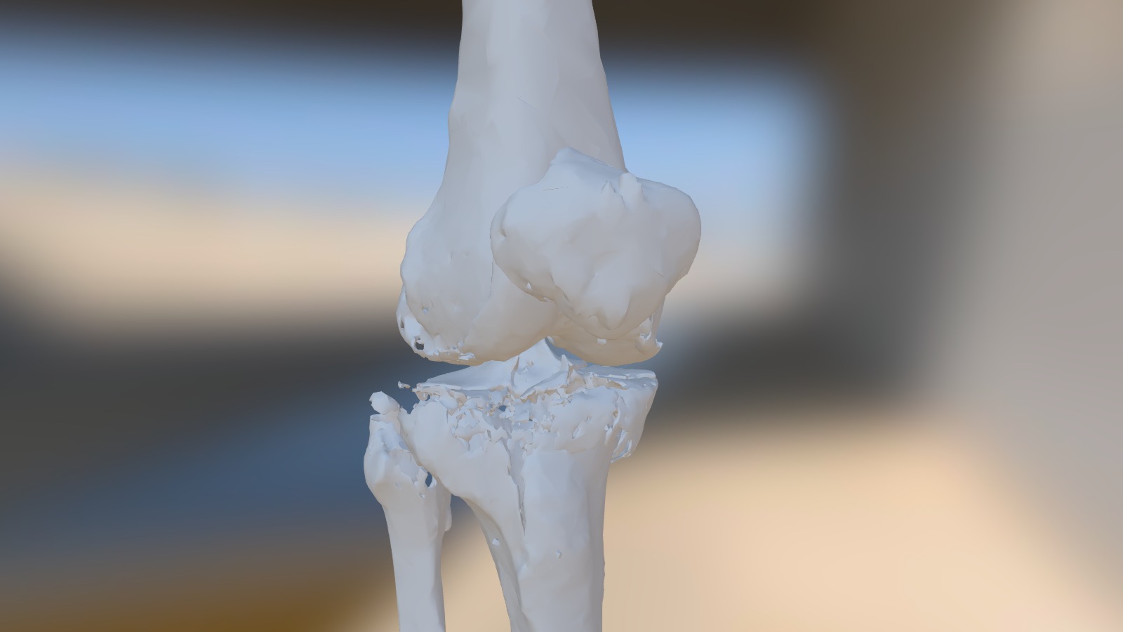 Knee - Proximal Tibia Fracture sku 044 - 3D model by orto3d [692e5c0 ...