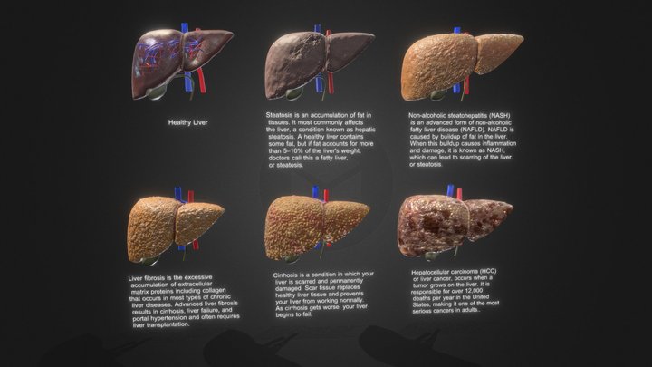 3D Liver Diseases 3D Model
