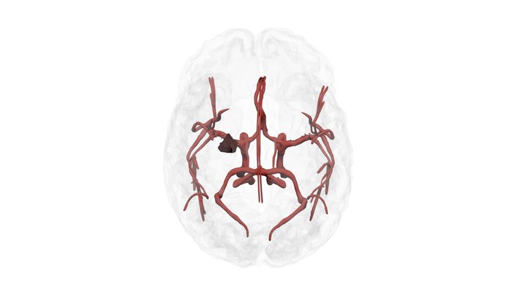 Hemorrhage_RAPID_copy 3D Model