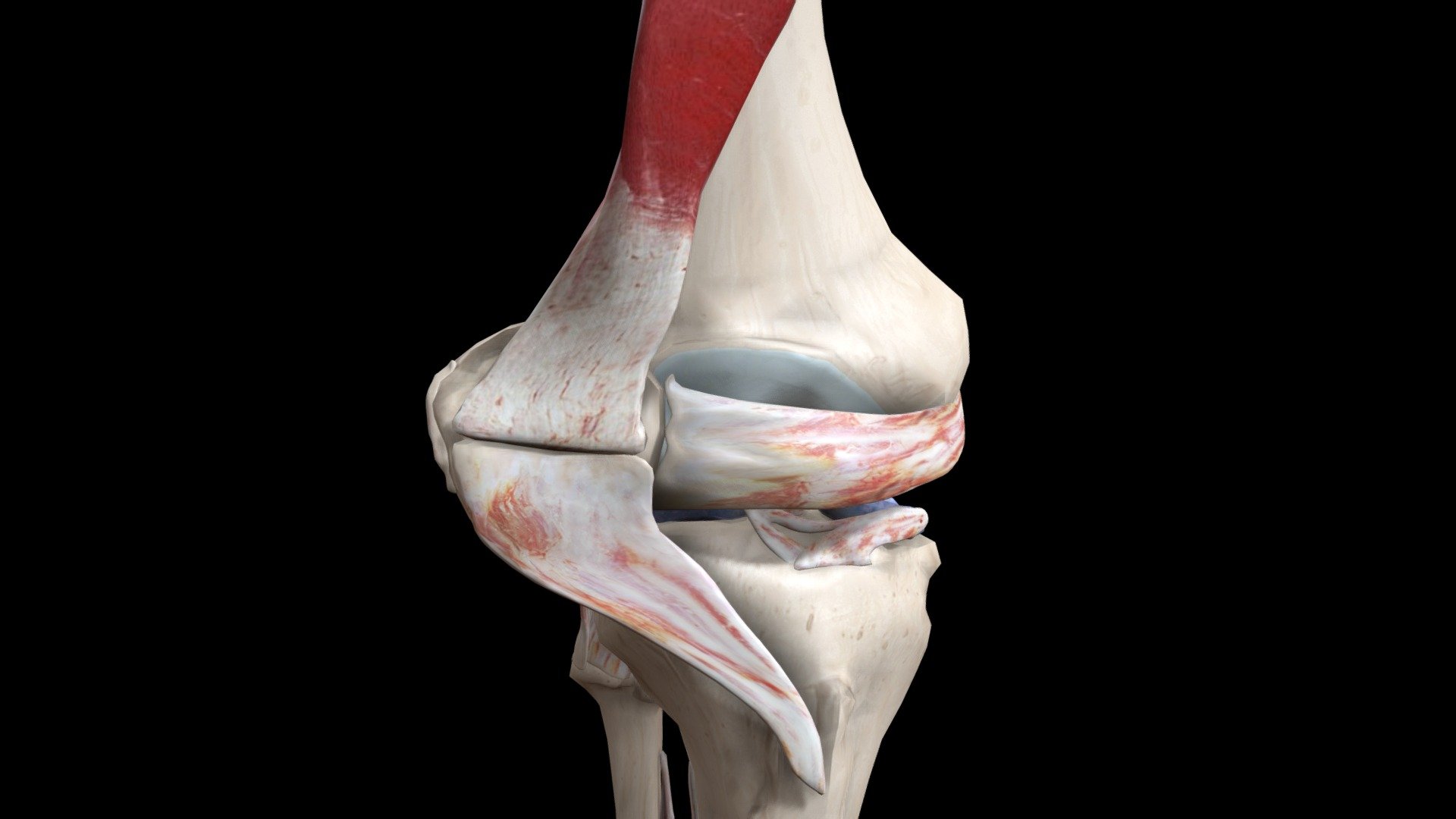 Patella Dislocated 3D model by Connections XR (connectionsxr