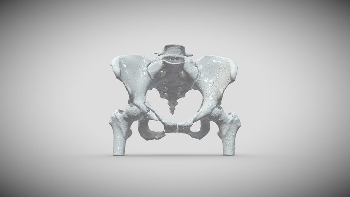 Pelvis Fracture 3D Model