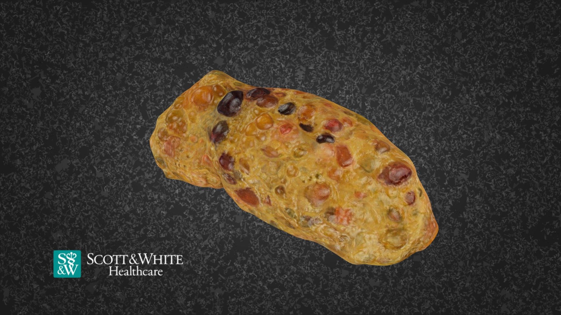 Kidney Polycystic S Fe 15197