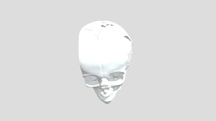 Haj-Congenital 3D Model