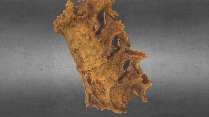 Ankylosing spondylitis 3D Model