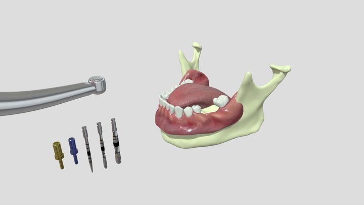 Implant site preparation 3D Model