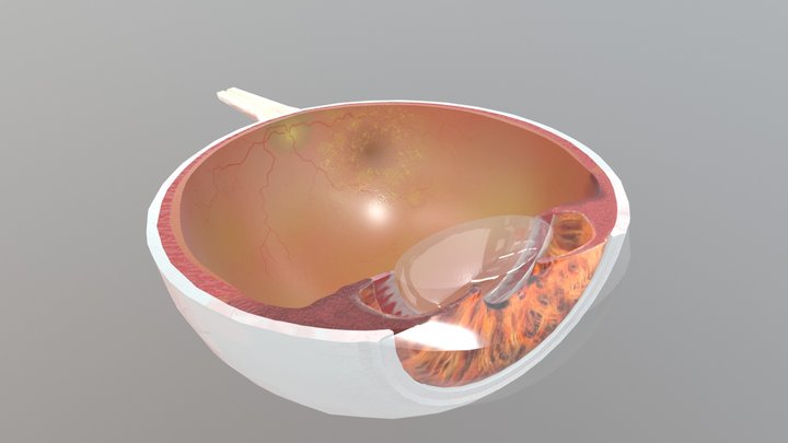 Eye Anatomy with Stargardt Macular Dystrophy 3D Model