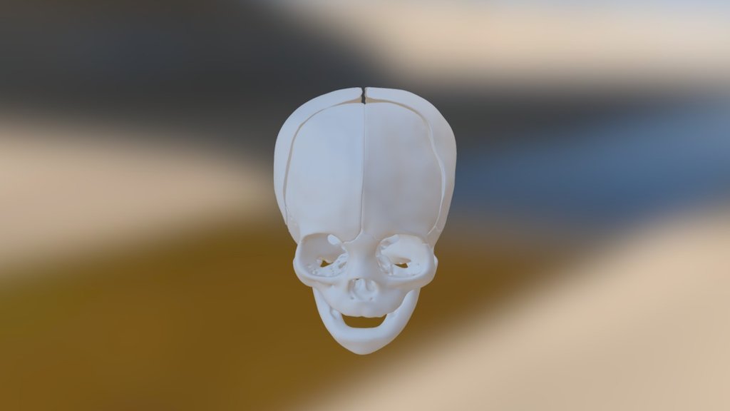 Metopic Synostosis skull