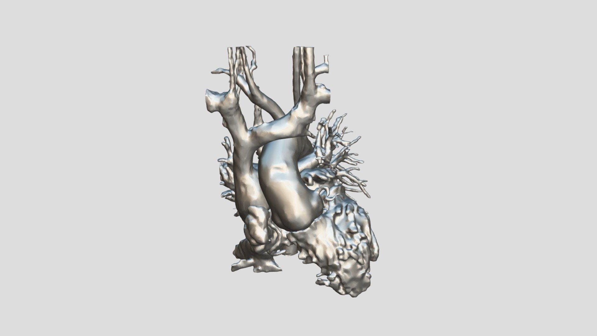 Hypoplastic Left Heart Syndrome - 3D model by Ainsley (@swainsley ...