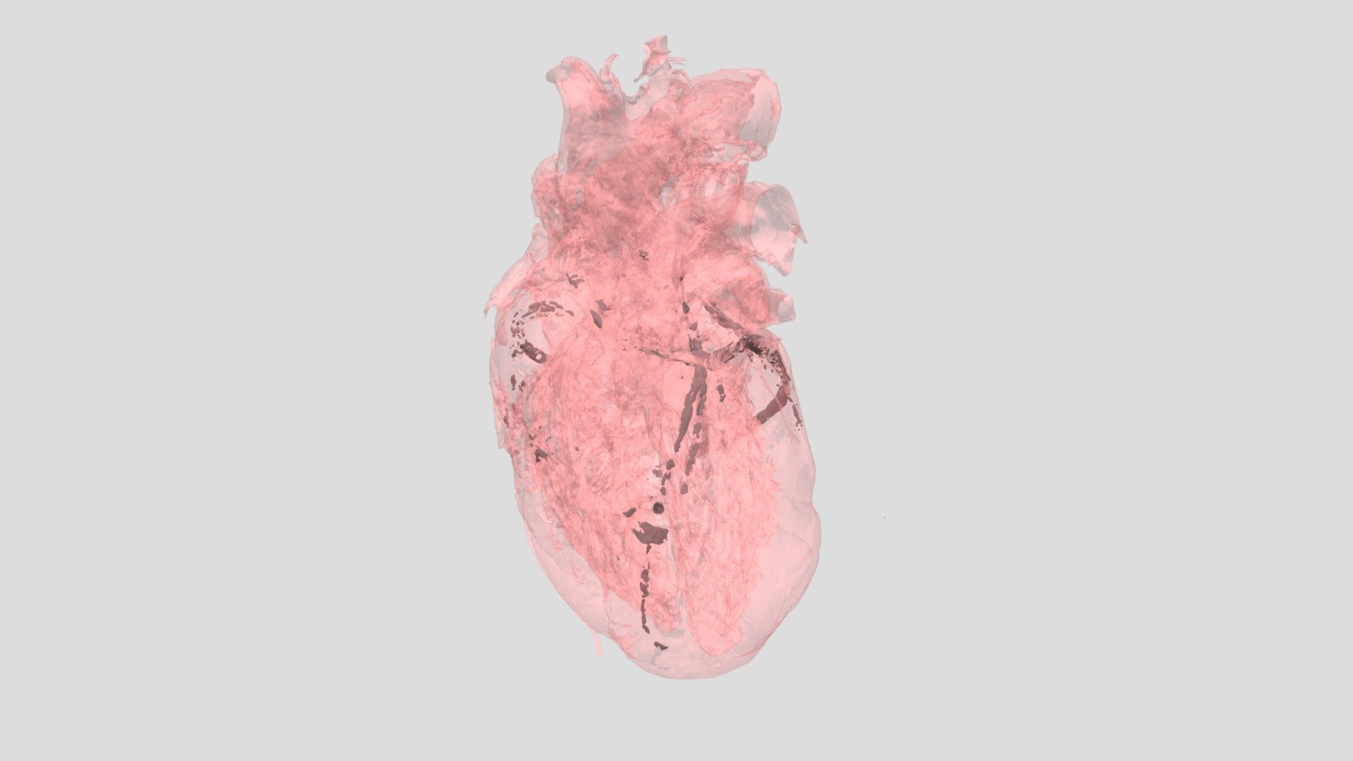 CAD Calcification: HH0207 - Download Free 3D model by VisibleHeartLabs ...