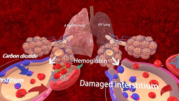 Medical: Lung model Interstitial Pneumonia – Kostenloses 3D-Modell STL