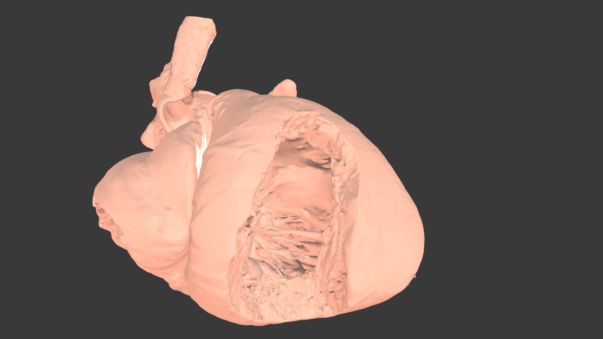 VSD #5 - {S,D,S} with muscular VSD - 3D model by heartmodels [6cd6551 ...