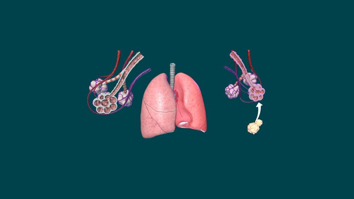Pathophysiology of Asthma 3D Model
