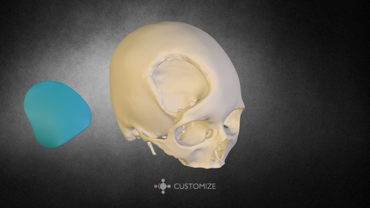 Cranioplastia Molde Customize - RJ - Brasil 3D Model