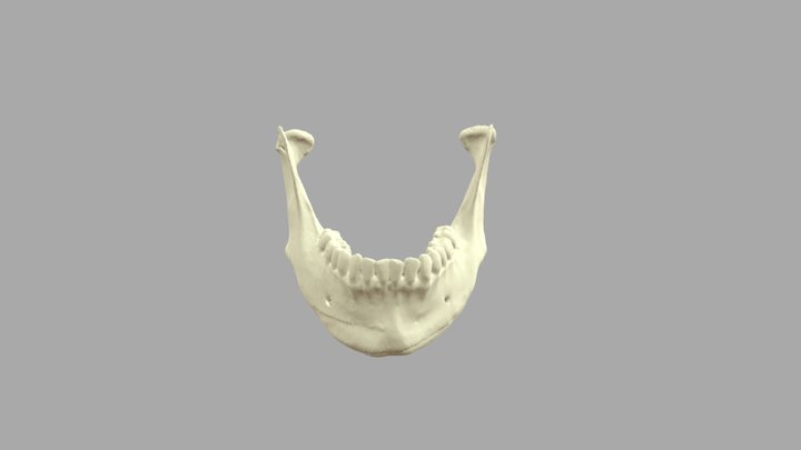 Madible fracture: Condylus 3D Model