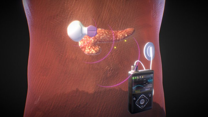 Artificial Pancreas | animated insulin pump 3D Model
