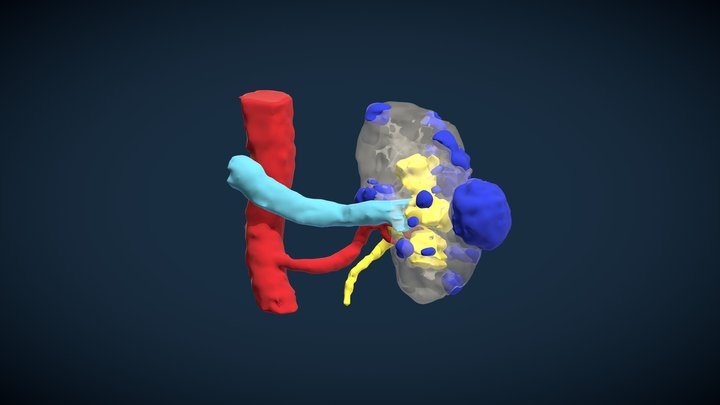 Left renal tumor (P.R.S.) 3D Model