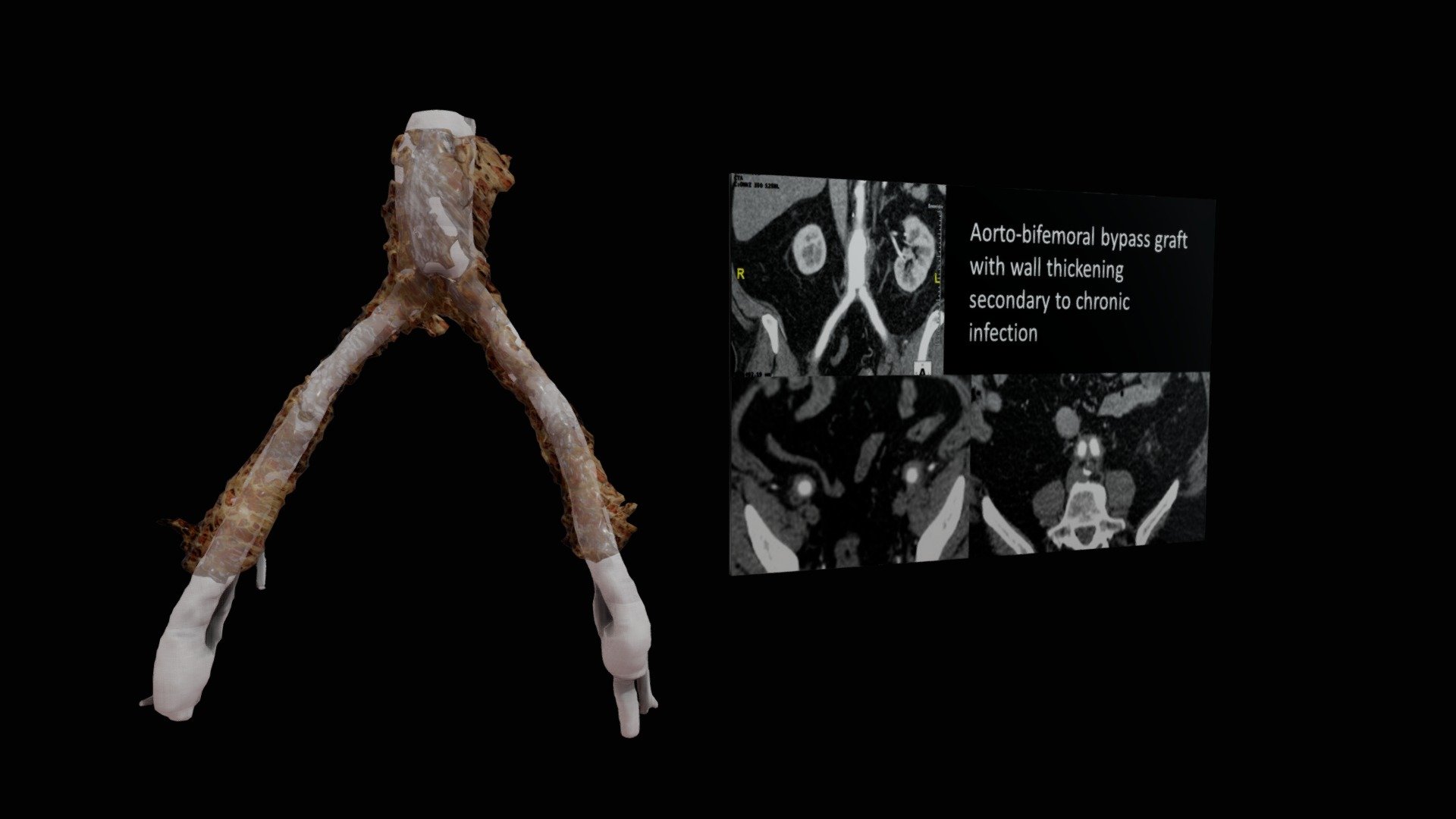 Aorto-bifemoral bypass graft chronic infection