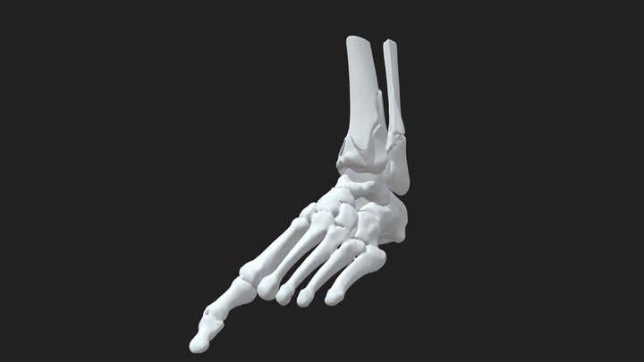 Left Foot Pilon Fracture Reconstruction 3D Model