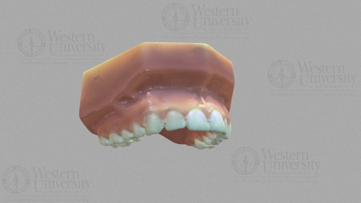 300071 Upper Teeth Orthodontic Model 3D Model