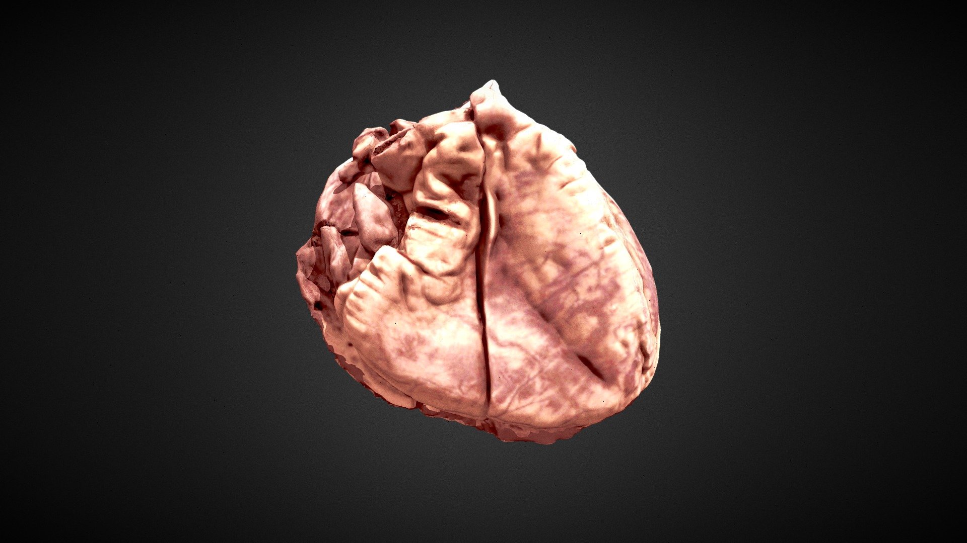 Heart ASD - 3D model by SD (@satishdesai) [6f4198b] - Sketchfab