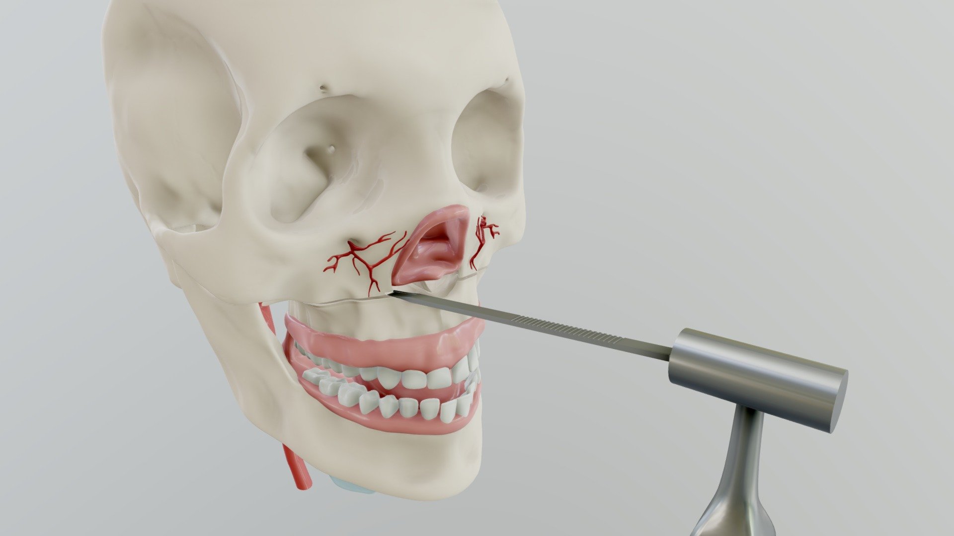 Le Fort 1 Step 4: Lateral Nasal Osteotomy - 3D model by AUmedart ...