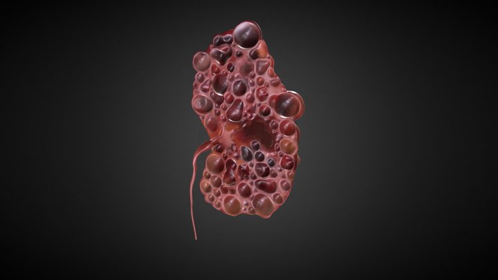Polycystic Kidney Cross-section 3D Model