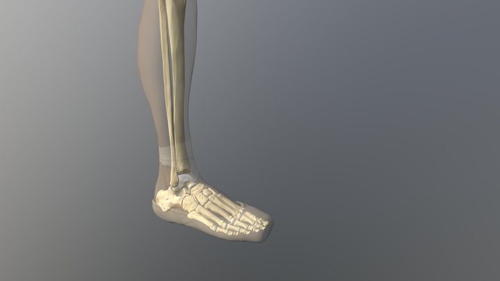 Fifth metatarsal Jones' fracture 3D Model