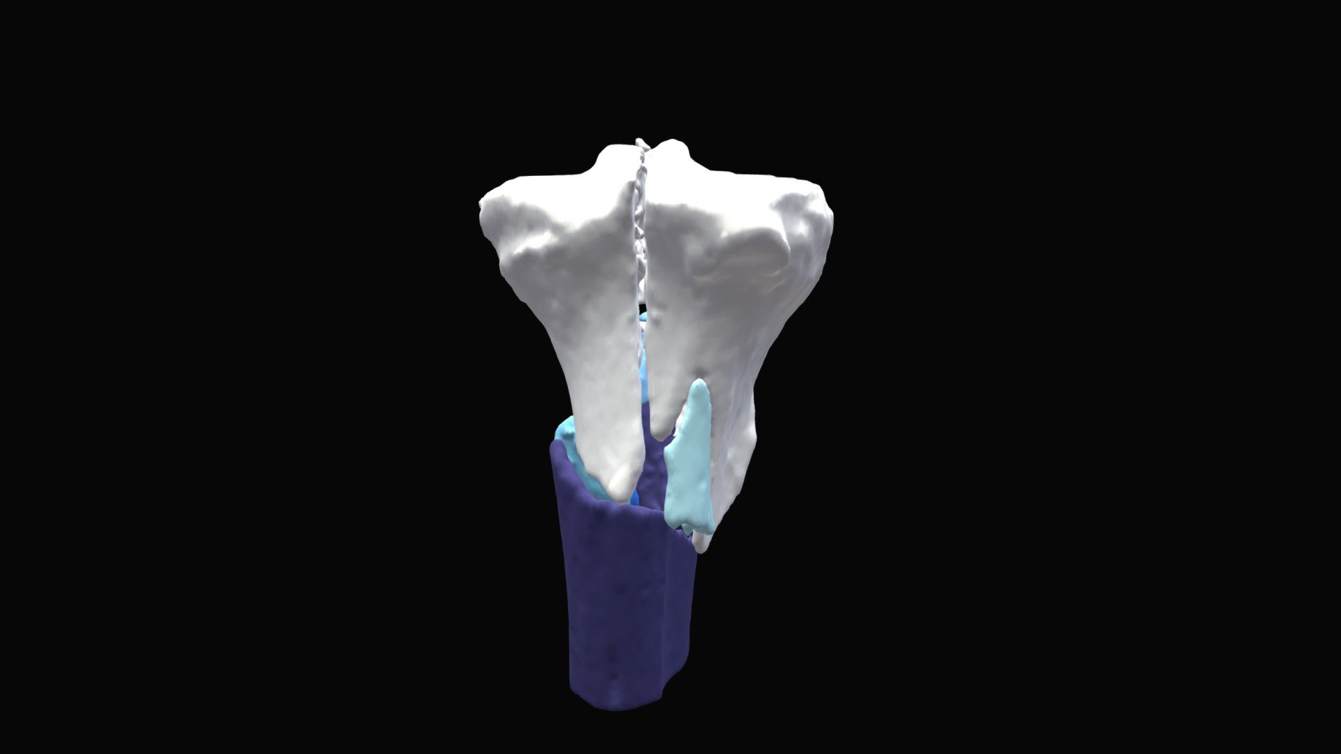 Session 4.07 | Proximal Tibia Fracture Nailing
