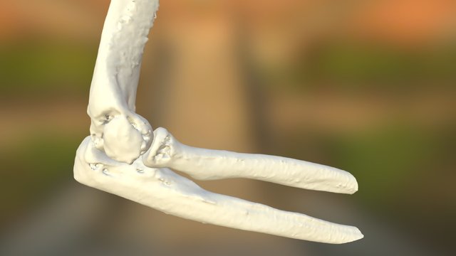 EMRT  - Elbow - Capitellum fracture 3D Model