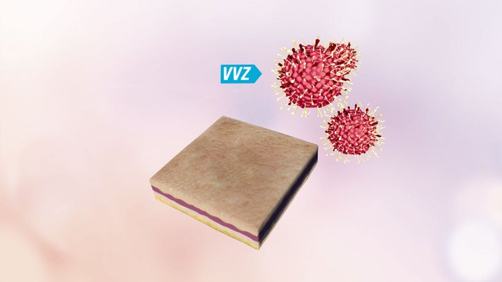 RA1 Herpes 3D Model