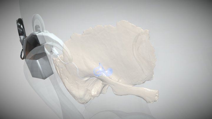Cochlear Implant 3D Model