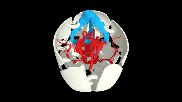 Vein of Galen Malformation 3D Model