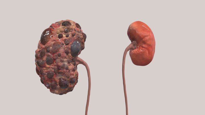 Polycystic kidney disease 3D Model