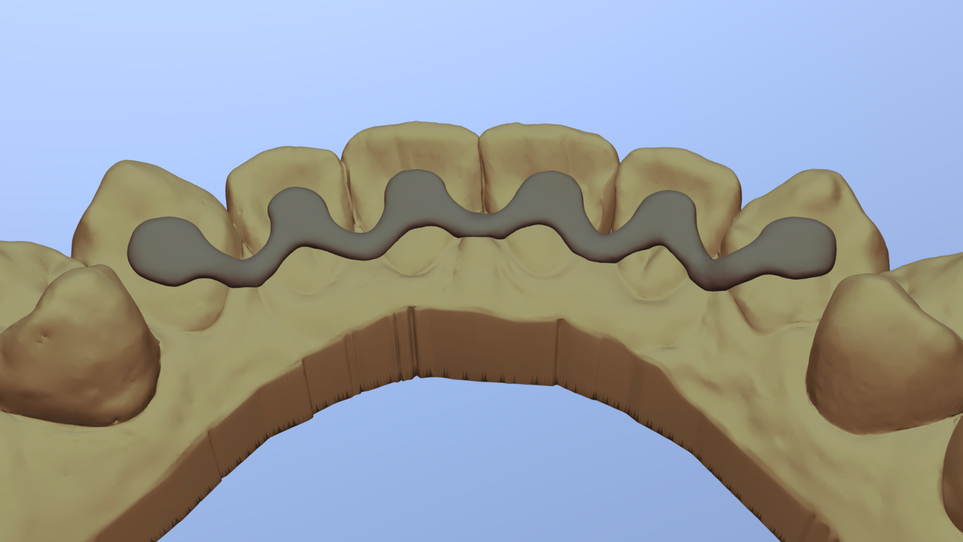 Ortho-retainer - 3D model by epres [71a2959] - Sketchfab