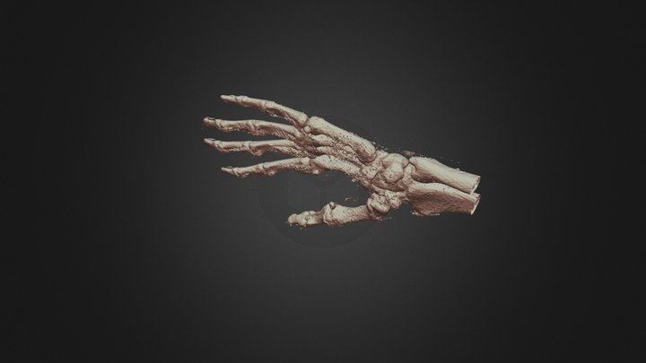 Tomographic Scan of Left Hand Bennett's fracture 3D Model