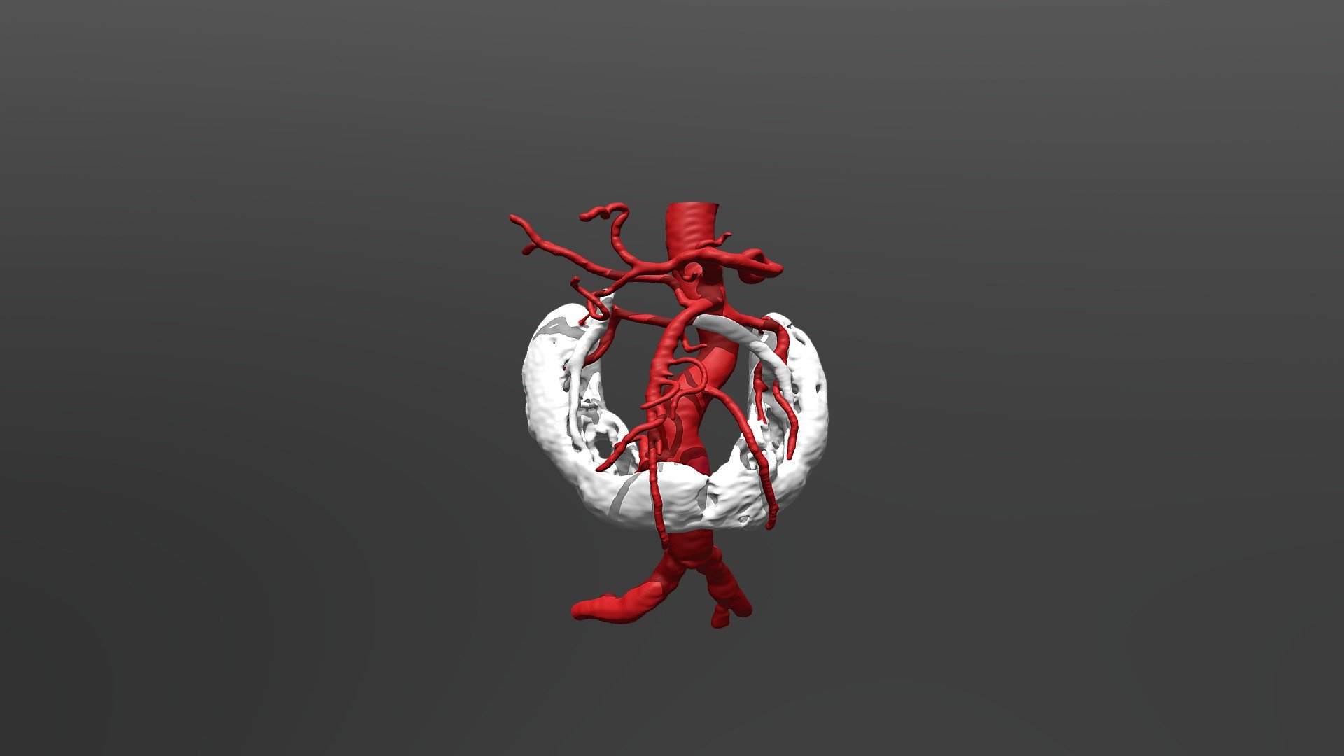 Aortic aneurysm with horseshoe kidney - Post