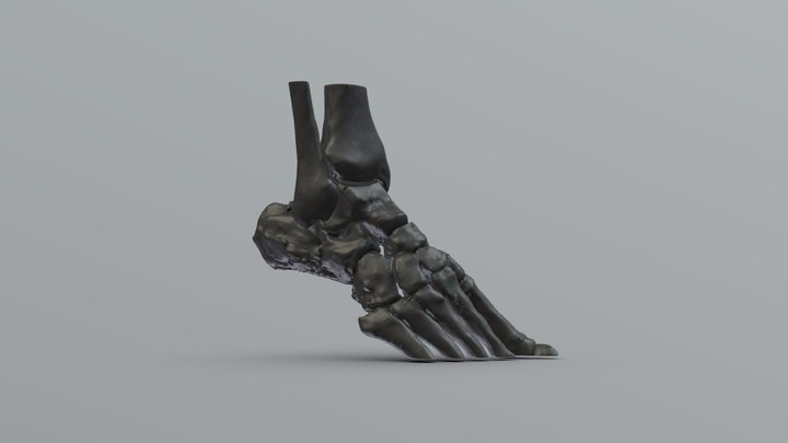 Heel fracture 3D Model