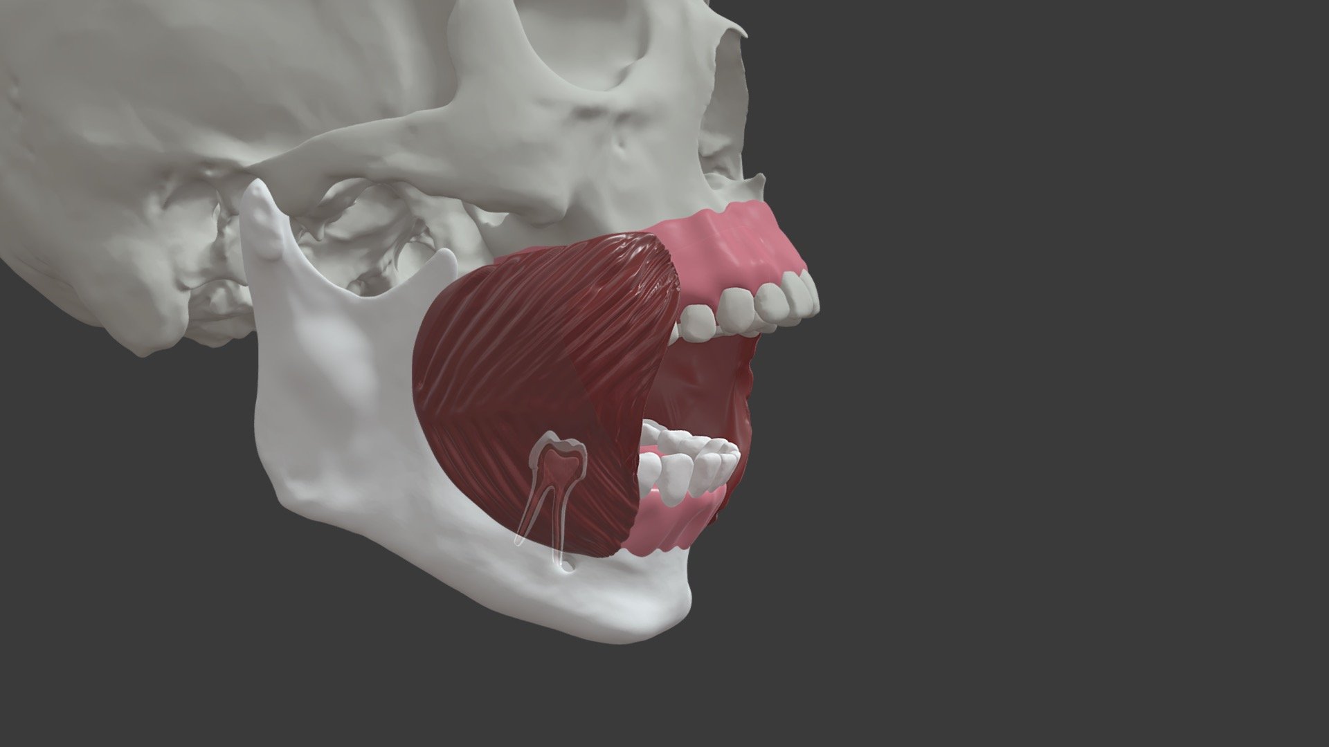 Stage 1 Mandibular Molar Infection Pathway-2 - 3D model by University ...