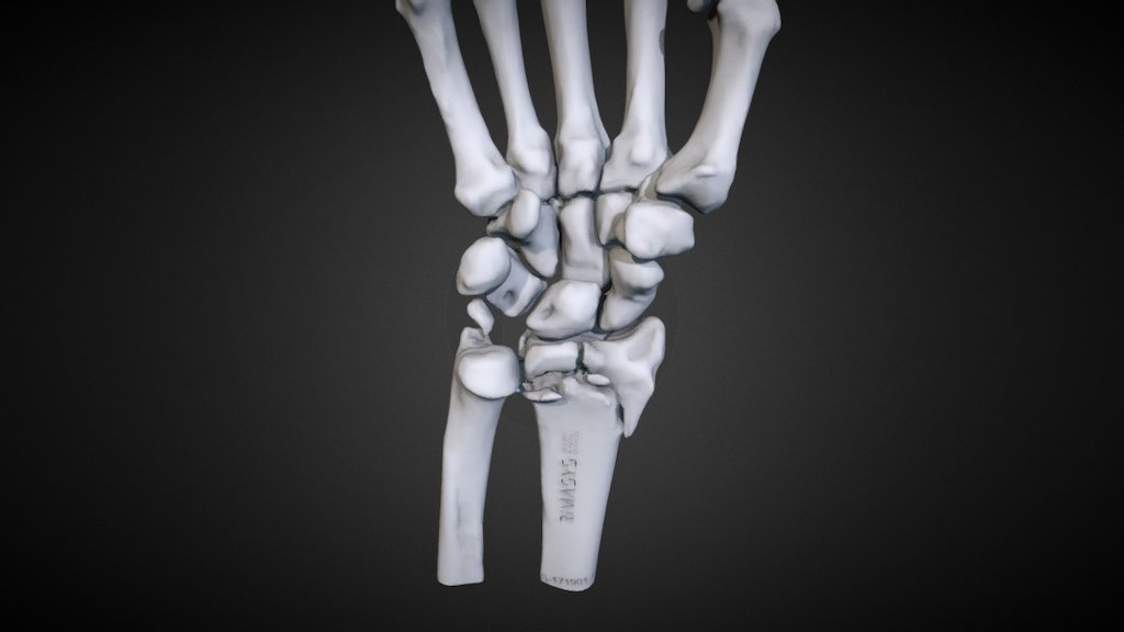 IBRA-Nov17 | #1-2 Distal Radius (S-171901-L)