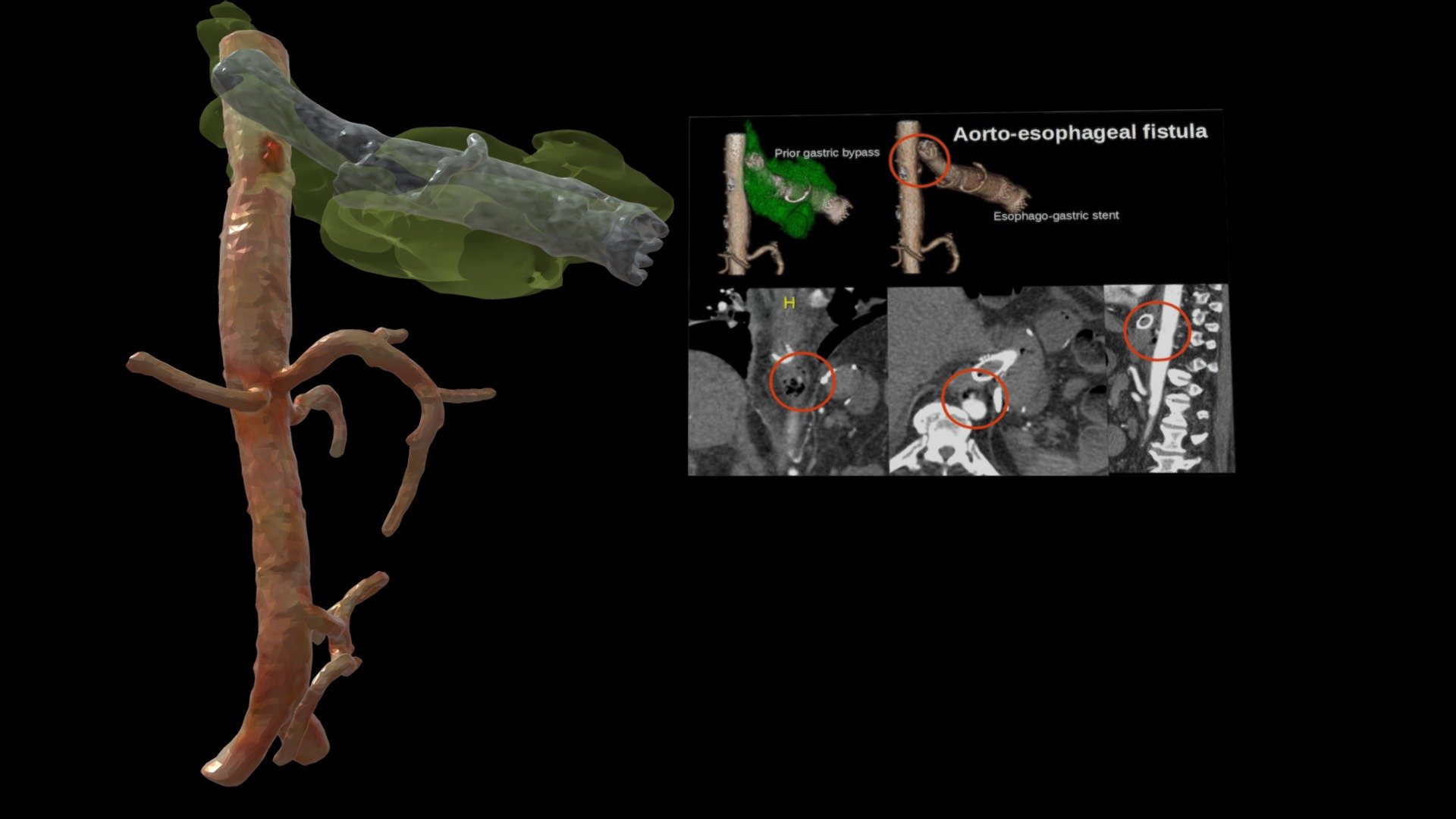 Aorto-esophageal fistula