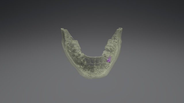 Tooth 35 3D Model