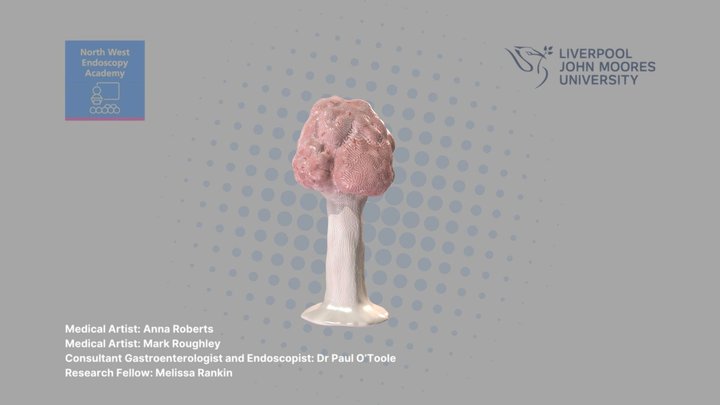 Large Pedunculated Polyp © 3D Model
