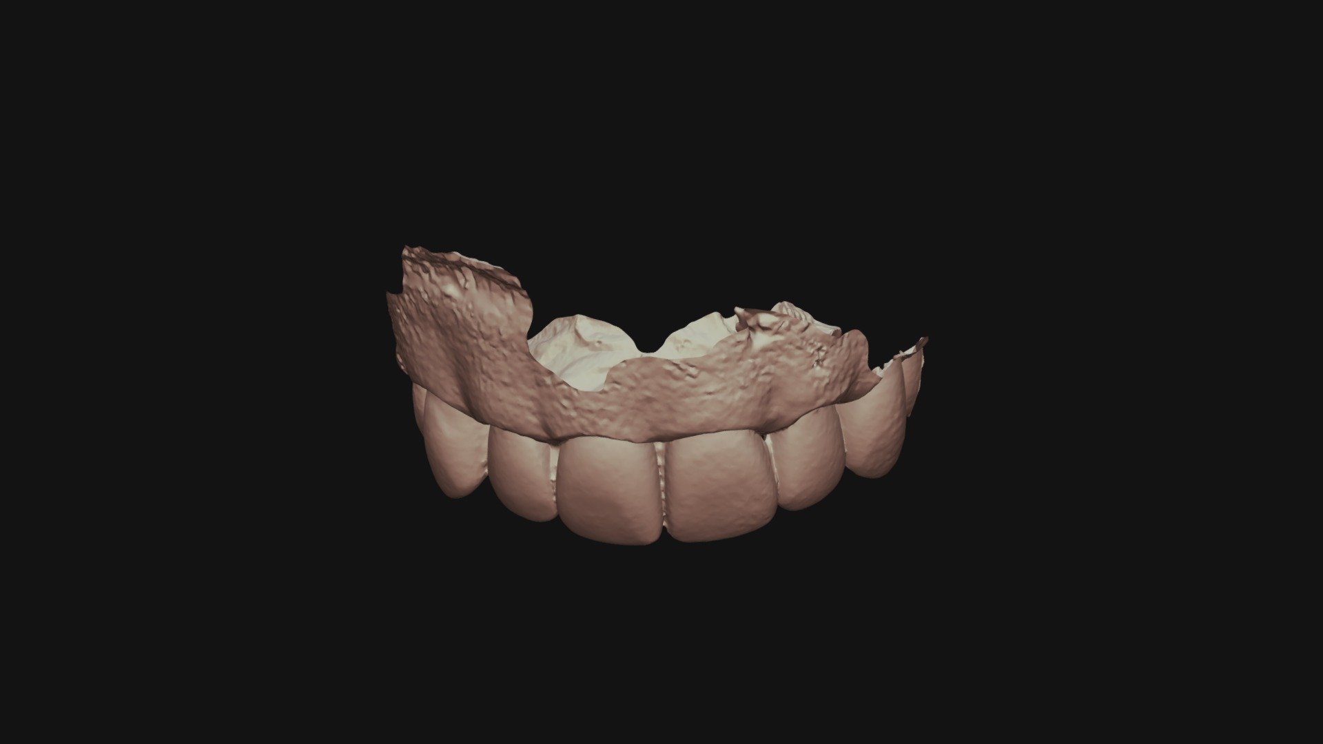 Group 3 - Tooth #9 - Class 3 Prep (1)