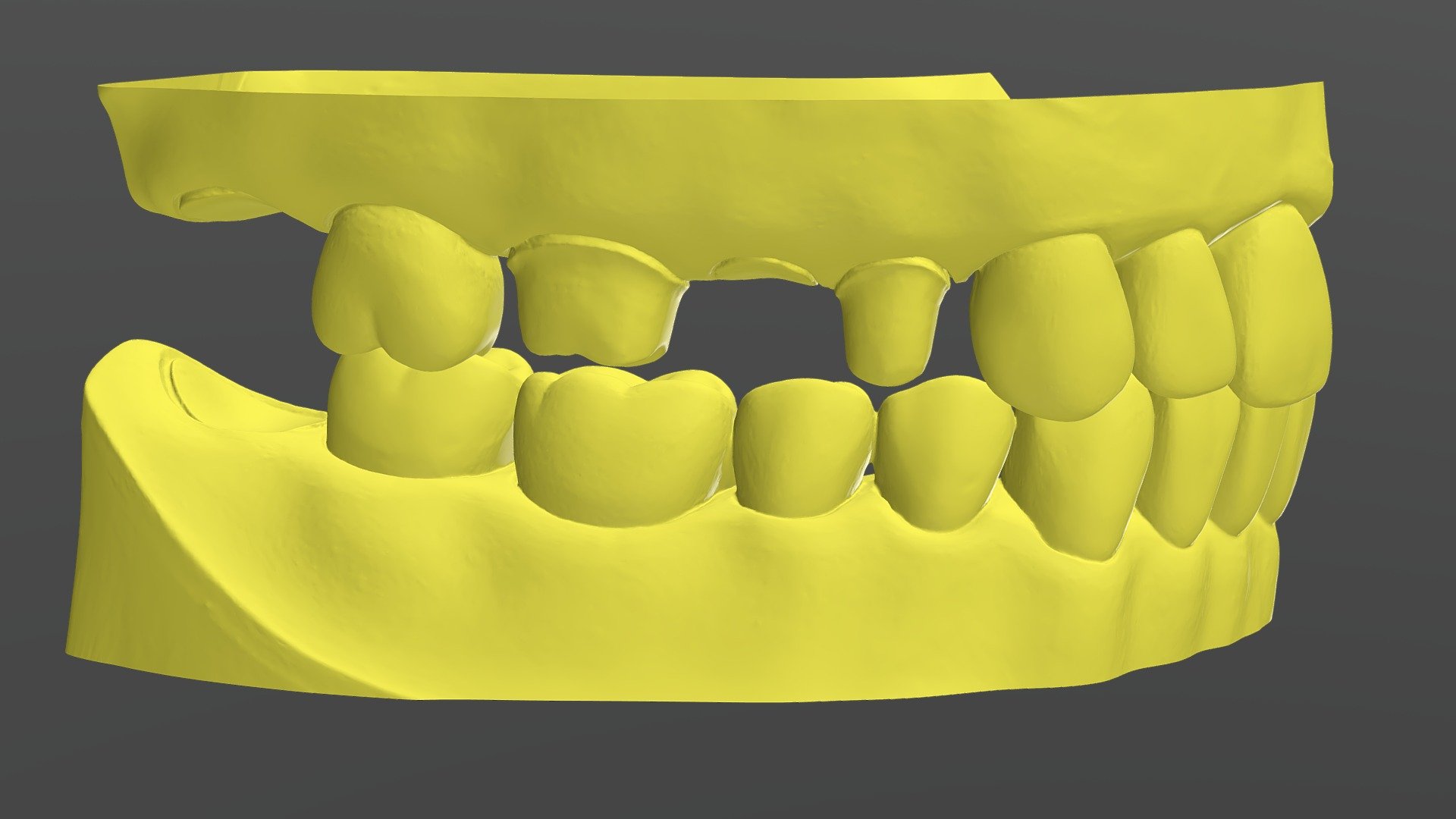 FPD All Ceramic Zirconia Preparations #3 to 5